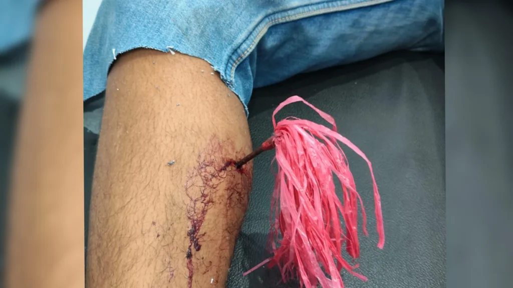 Cekcok di Acara Joget Berujung Pembusuran, HS Dilarikan ke RSUD Butur